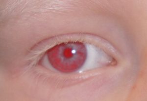 Albino oog