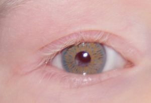 Albino oog met irisprintlens