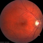 Fundus foto (JGK) Fundus foto (JGK)