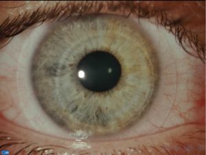 Op dit oog een hybride contactlens Op dit oog een hybride contactlens