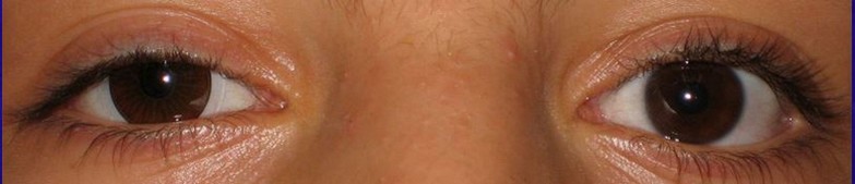 Met cosmetische lens