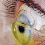 Ptosis lens ptosis scleralens