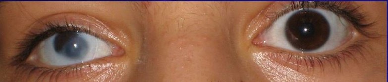 Zonder cosmetische lens