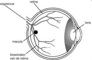 Schematisch oog met cataract Schematisch oog met ooglens waar cataract voorkomt