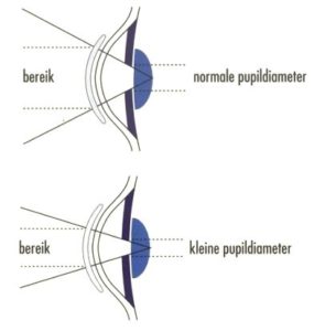 Invloed pupildiameter