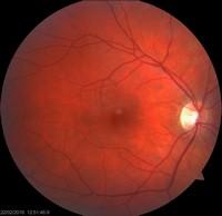 Fundus rechter oog